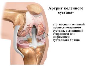 Артрит колена
