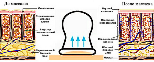 Баночный массаж от целлюлита