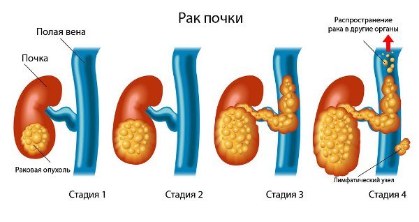 Рак почек