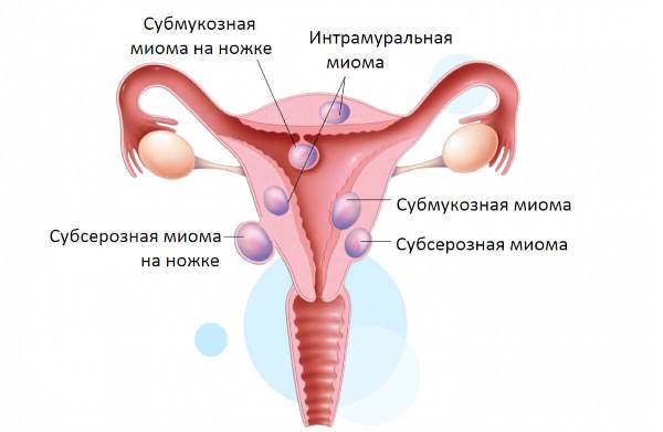 Миома матки