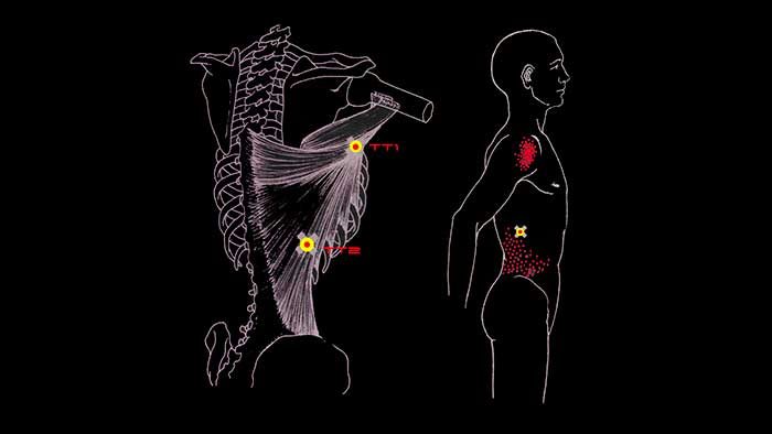 триггерные точки широчайшей мышцы спины