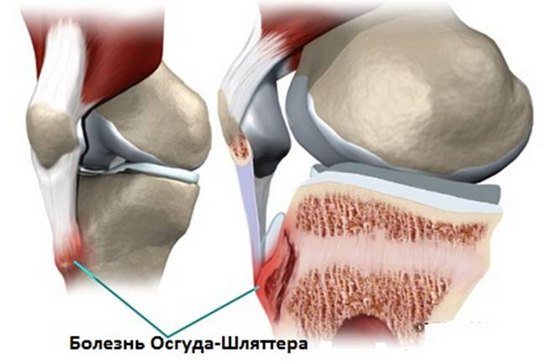 Паталогия Осгуда-Шлттера