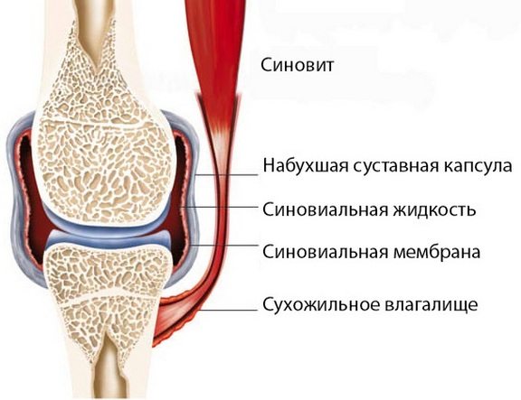 Синовит коленного сустава